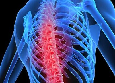 остеохондроз грудного отдела позвоночника